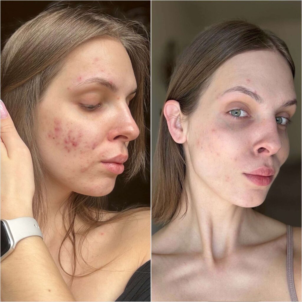 trądzik hormonalny suplementacja omega 3 przed i po efekty pielęgnacja skóry